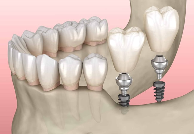 Dental implant illustration showing natural teeth alongside prosthetic implant-supported crowns on jawbone model.
