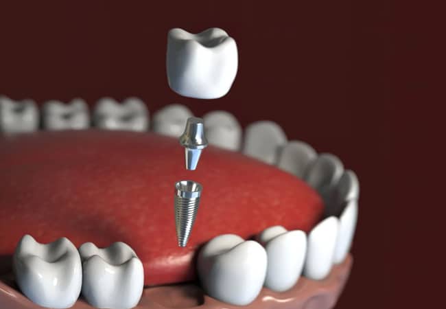 Dental implant procedure demonstration showing tooth implant placement in model jaw with prosthetic tooth.