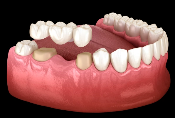img-Crowns-Bridges-Dental-Bridges