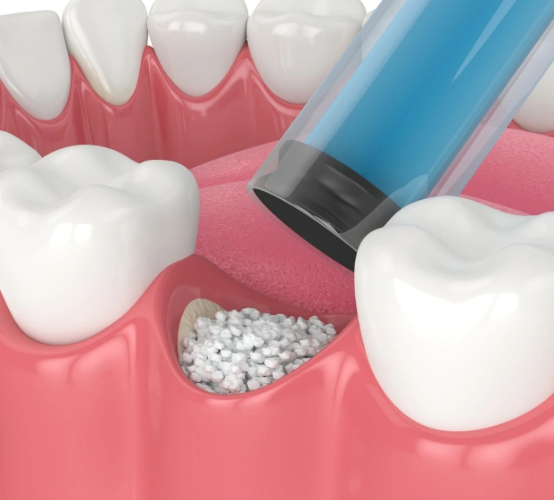 Bone Grafting for Dental Implant Success