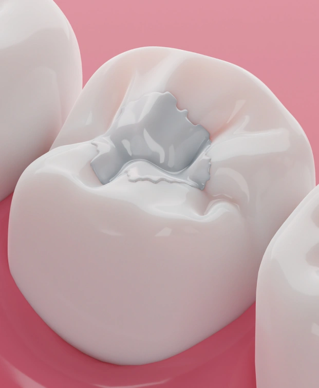 img-dental-fillings