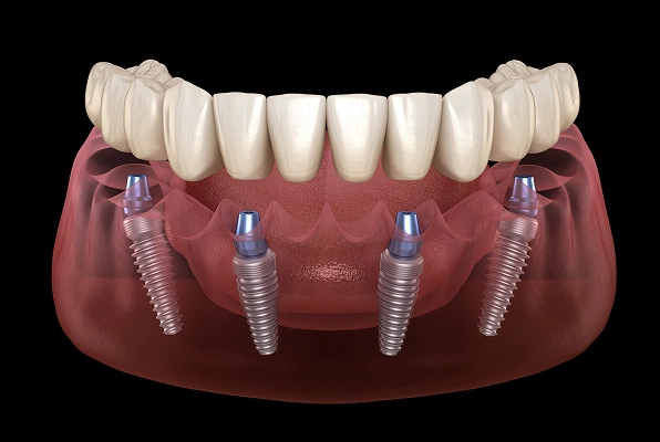 img-implant-supported-dentures-Fixed Implant-Supported Dentures