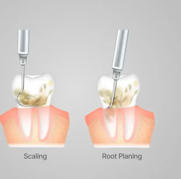 Diagram comparing dental scaling and root planing procedures on tooth and gum illustration.