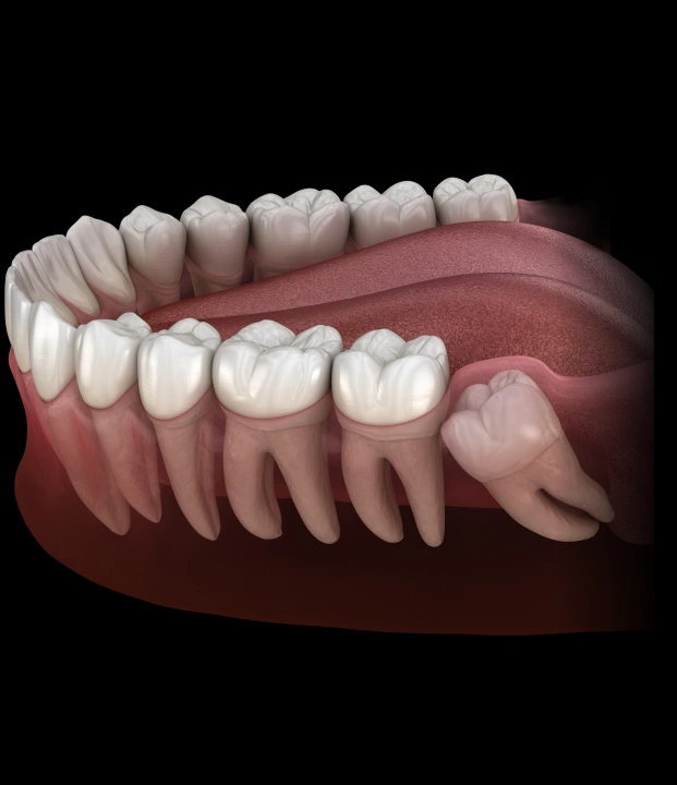 Safe, Calm, and Comfortable Wisdom Teeth Care